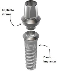 Iš ko susideda implantas