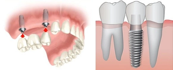 dantų implantavimas vilniuje City-Dent