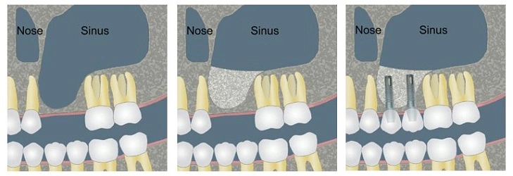 kaip vyksta dantų implantavimas