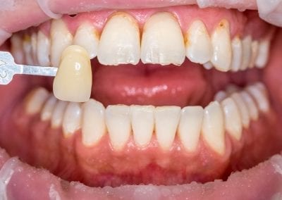 dantų balinimas