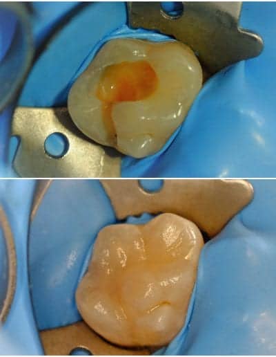 dantų karieso gydymas pavyzdys 1