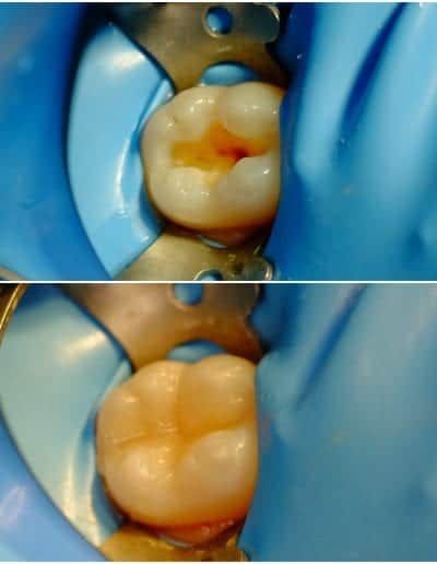 dantų karieso gydymas pavyzdys 2