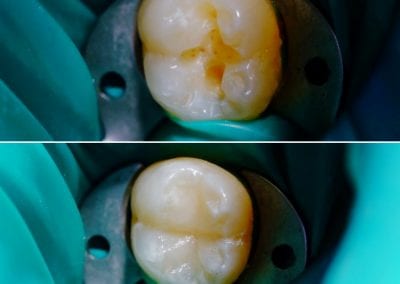 dantų karieso gydymas pavyzdys 3