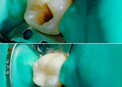 dantų karieso gydymas pavyzdys 4
