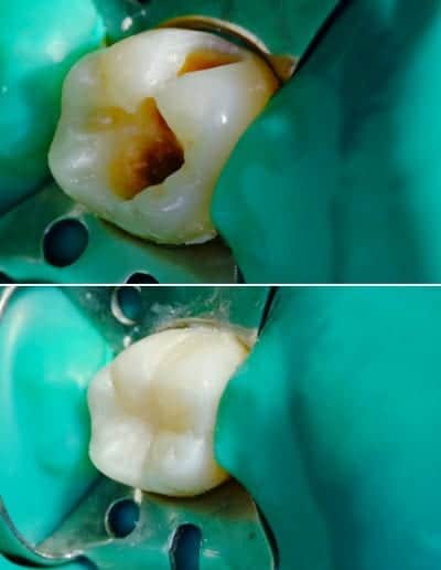 dantų karieso gydymas pavyzdys 4