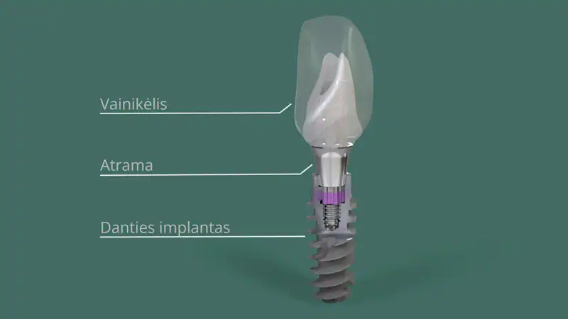 Iš ko susideda danties implantas – City-Dent